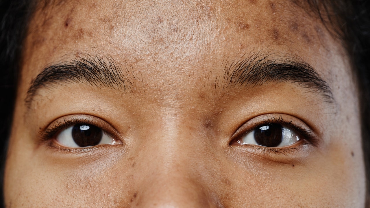 „Zweite Pubertät“ könnte Ihre Akne im Erwachsenenalter verursachen, Dermatologen erklären, warum