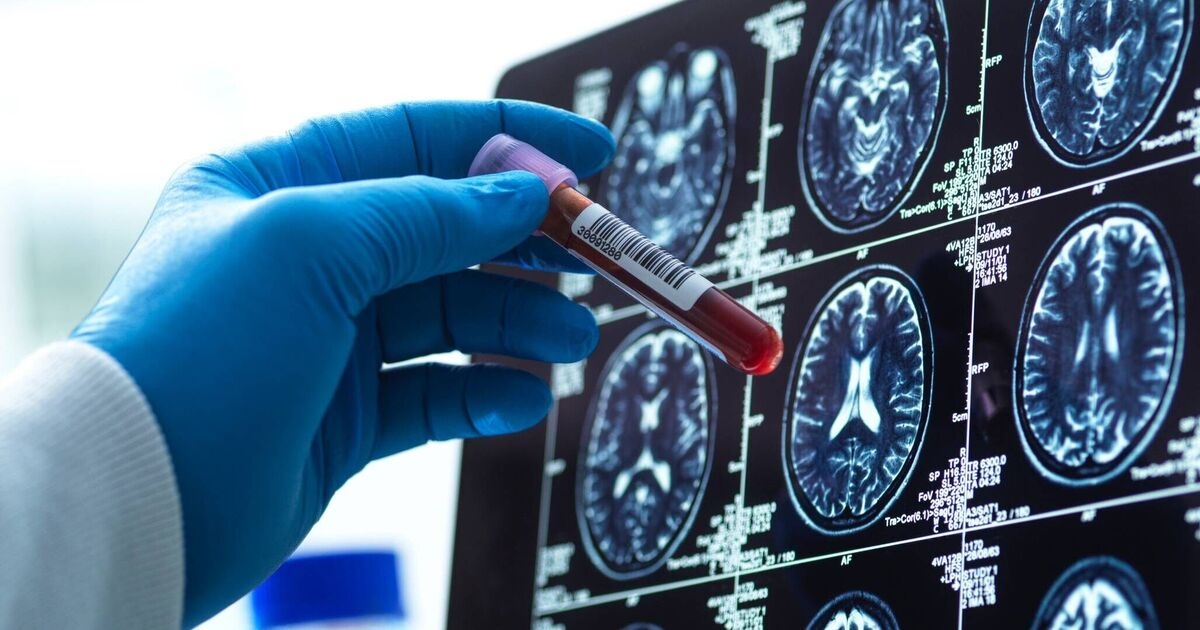 Una innovadora prueba de sangre diagnostica el Alzheimer de forma temprana con una precisión del 95 %
