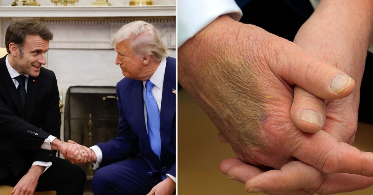 Trump health fears explode after mysterious dark mark seen on US president's hand