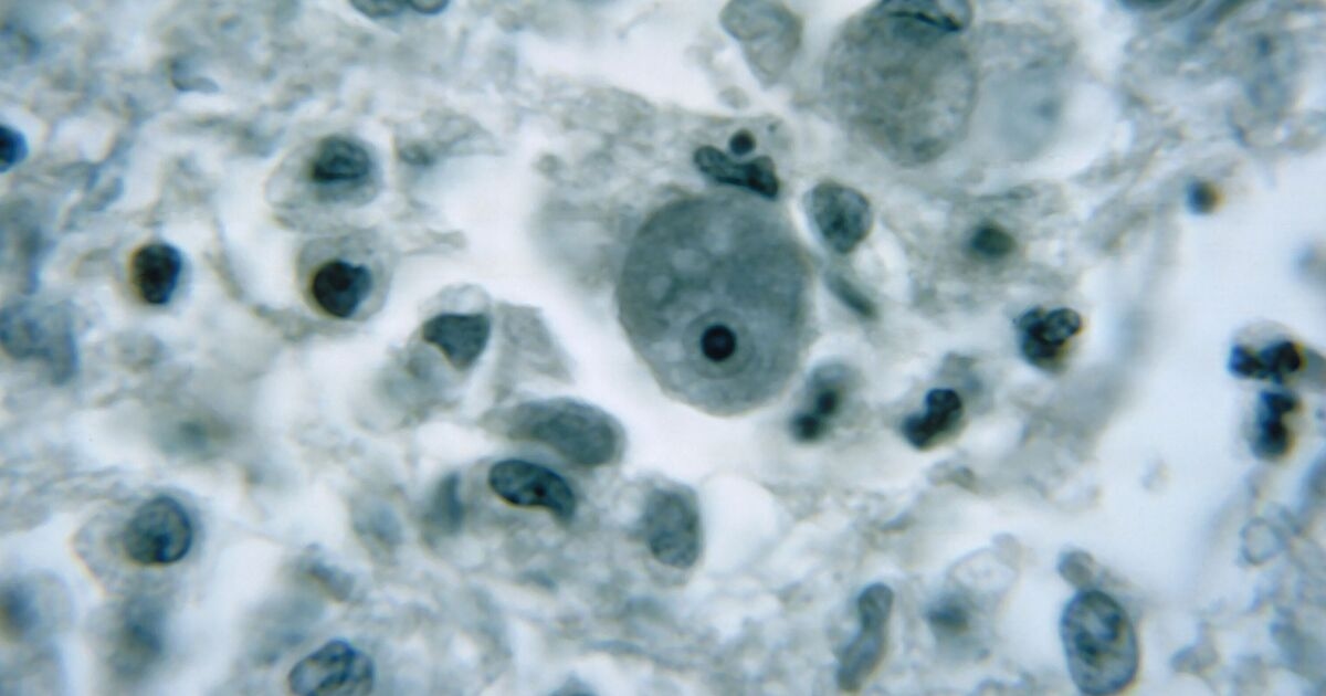 Horror as nine-year-old dies from a rare infection caused by ‘brain-eating amoeba’