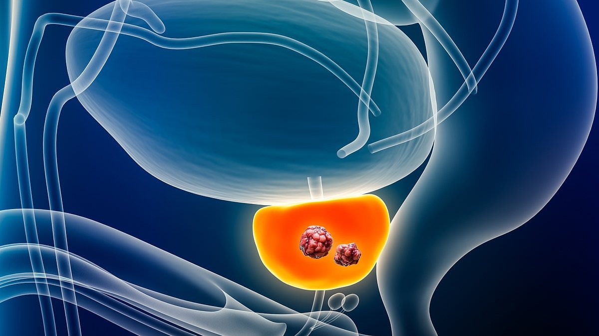 AI test could help to cut the risk of dying from prostate cancer by half, study suggests