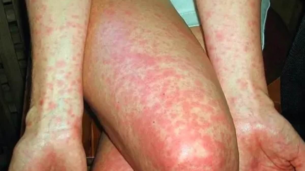 Urgent warning as Aussie state records sixth case of deadly disease this year