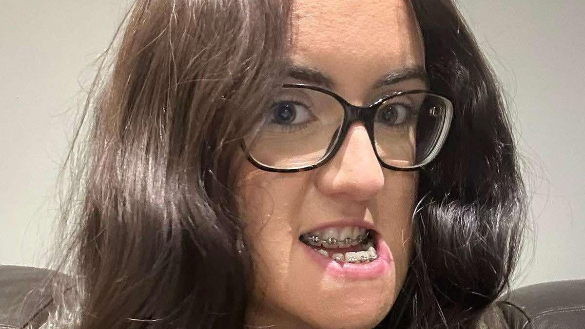 Mulher de 26 anos revela transformação surpreendente após cirurgia brutal de cinco horas para corrigir mordida cruzada profunda: 'A dor valeu a pena'