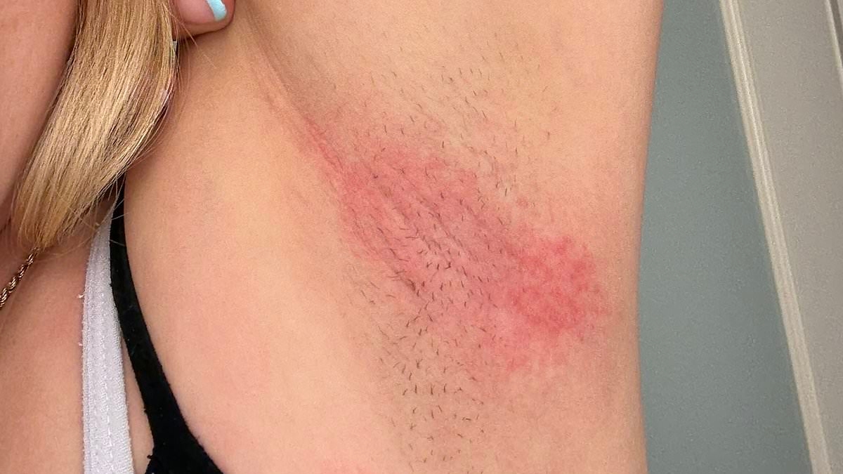 El popular desodorante deja a las mujeres con quemaduras químicas agonizantes mientras los expertos emiten una advertencia urgente
