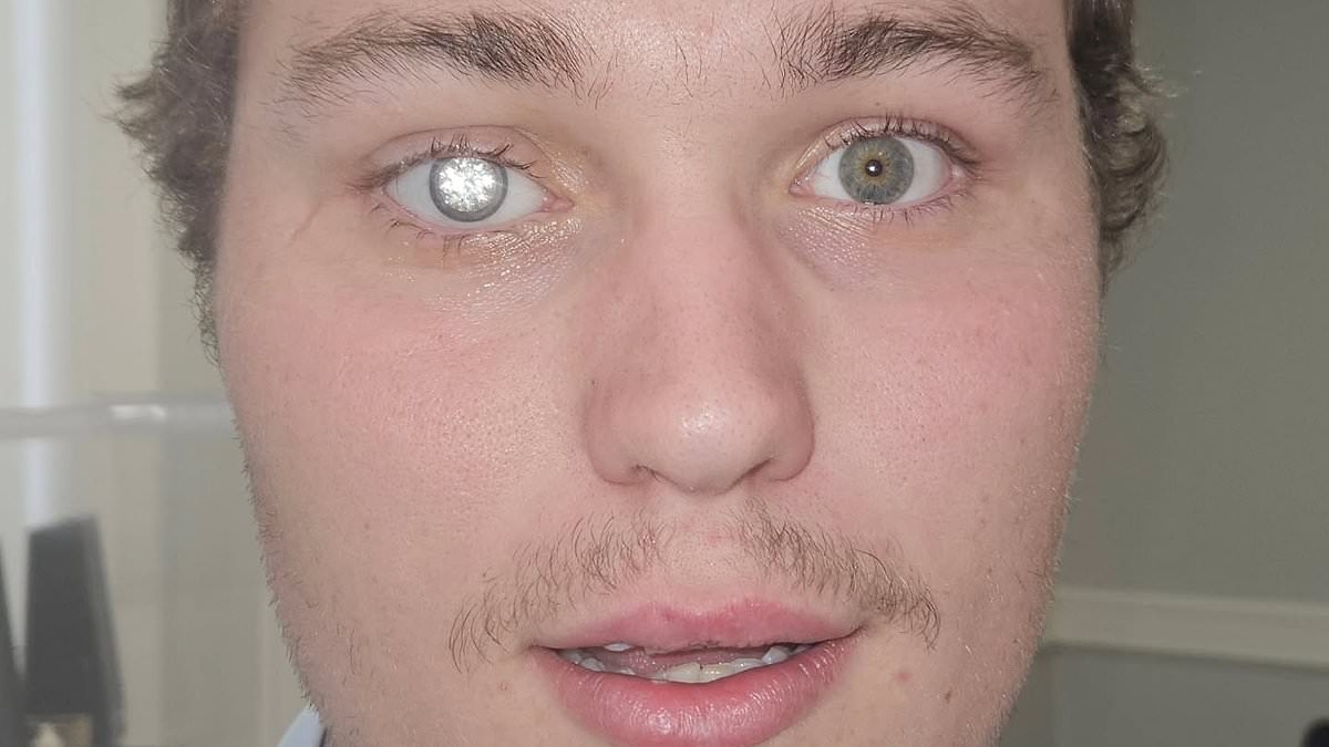 A real-life Bond villain! Jewellery store owner has a 2-carat DIAMOND embedded into his artificial eye
