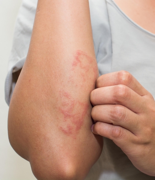 Yapay zeka dermatitin daha doğru teşhis edilmesini sağlayacak