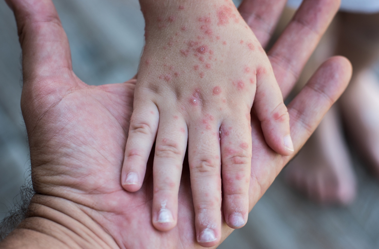 Measles in Mexico: Symptoms and How to Know if I'm Vaccinated