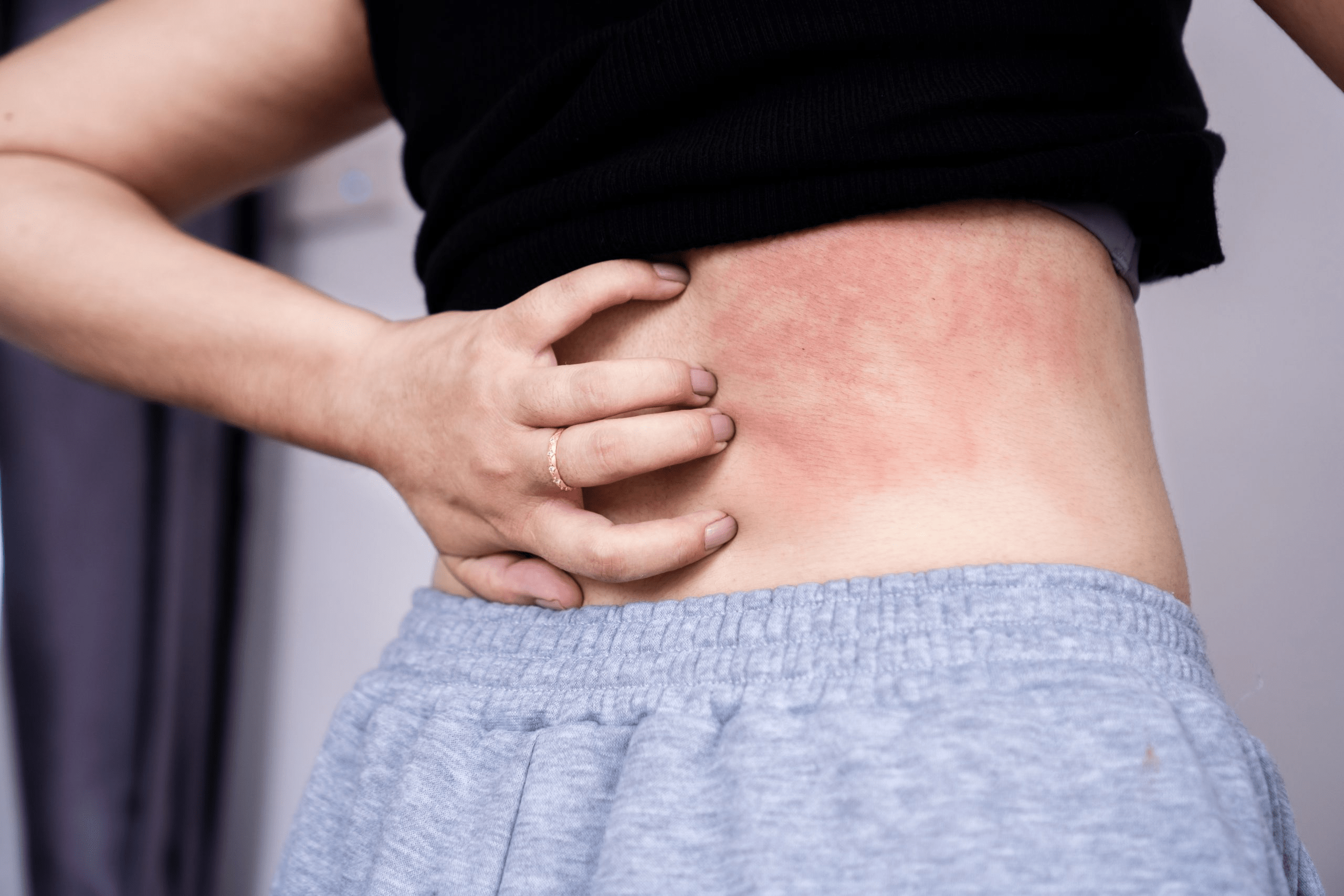 ¿Cuáles son los mejores tratamientos para la urticaria crónica?