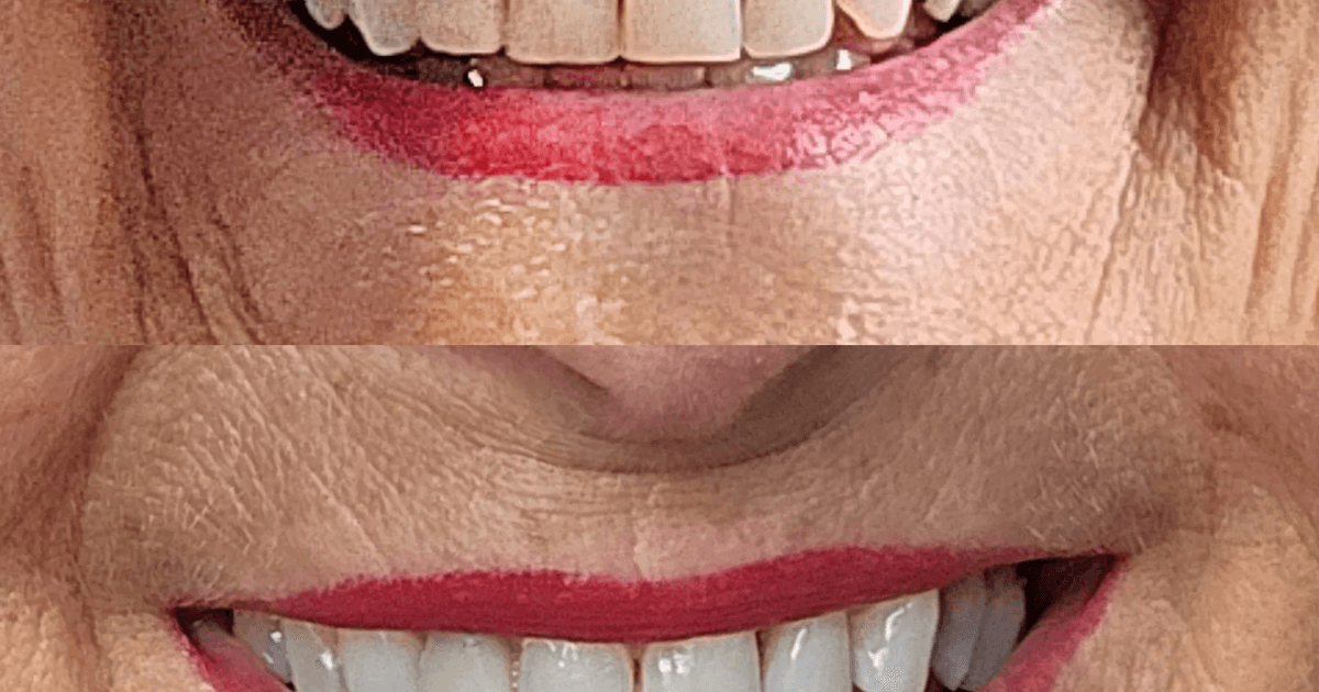 El kit de blanqueamiento dental que hizo que la sonrisa de una mujer de 77 años "luciera increíble" tiene un 20% de descuento