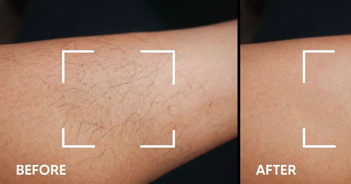 'Painless' hair removal device that works in 'weeks' and saves on waxing is £140 off