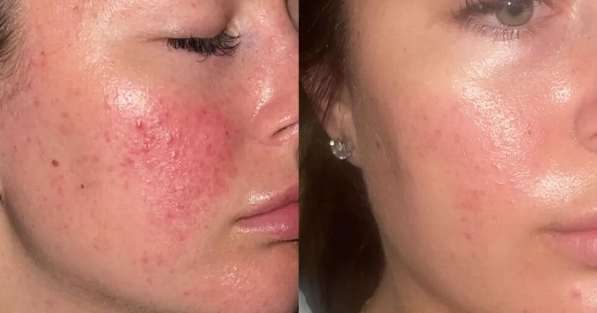 47 Skin's 'life-changing' skincare products for spot-prone teens are now 10% off