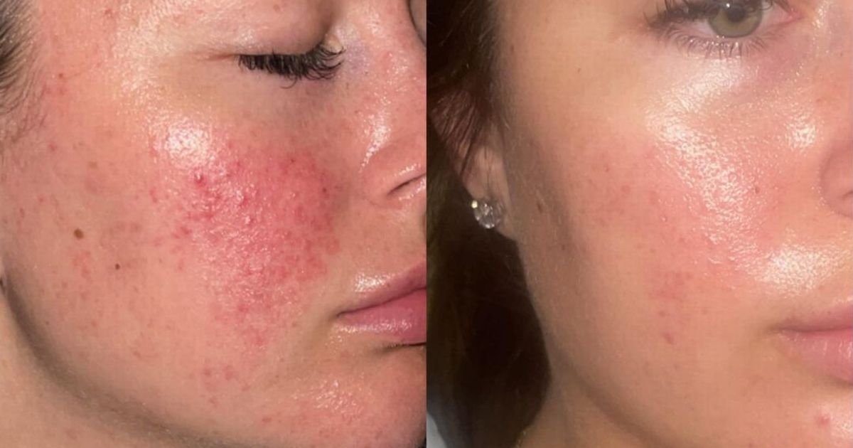 47 Skin's 'life-changing' skincare products for spot-prone teens are now 10% off