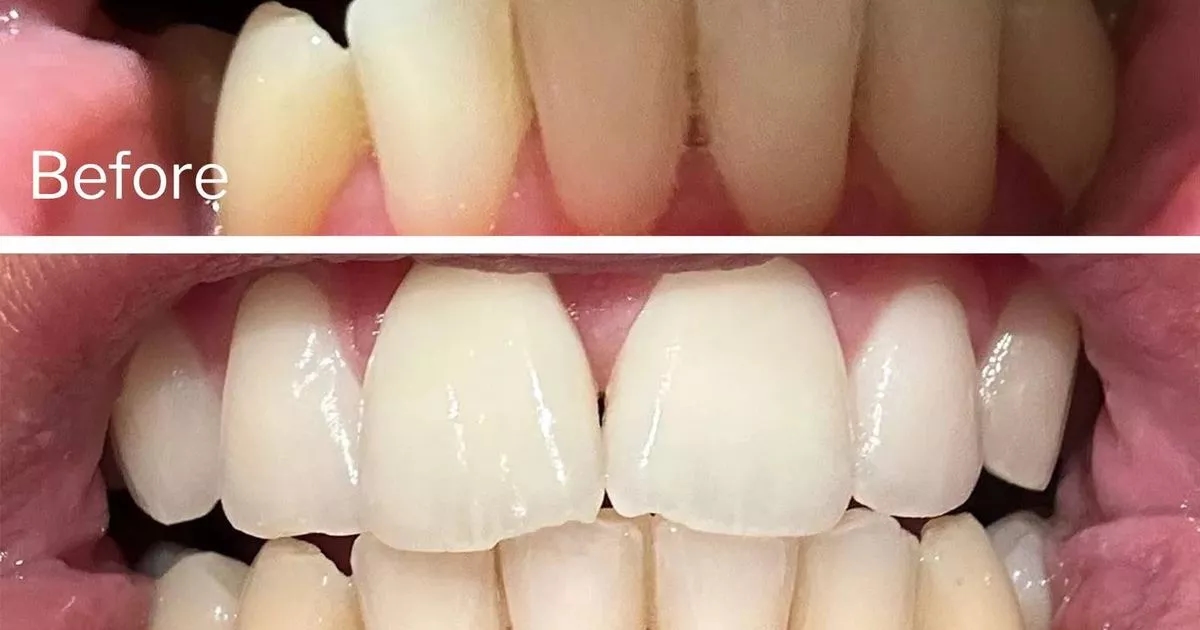 Compradores de tiras de clareamento dental de 95 centavos apoiadas por dentistas continuam dizendo que 'comprarão novamente'