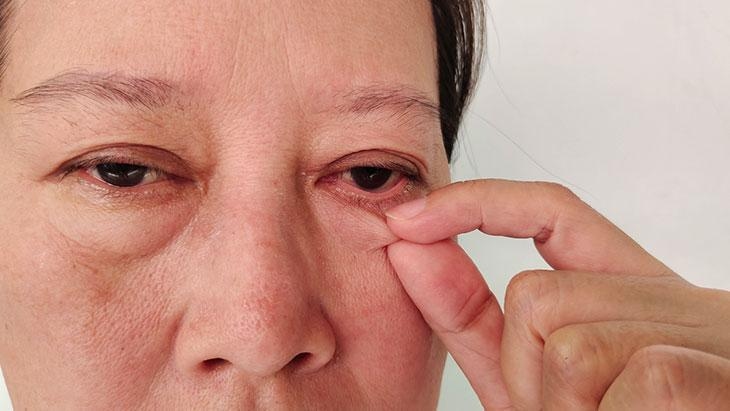 Es verursacht Rötungen und Brennen in den Augen! Es kann zu Sehverlust kommen.