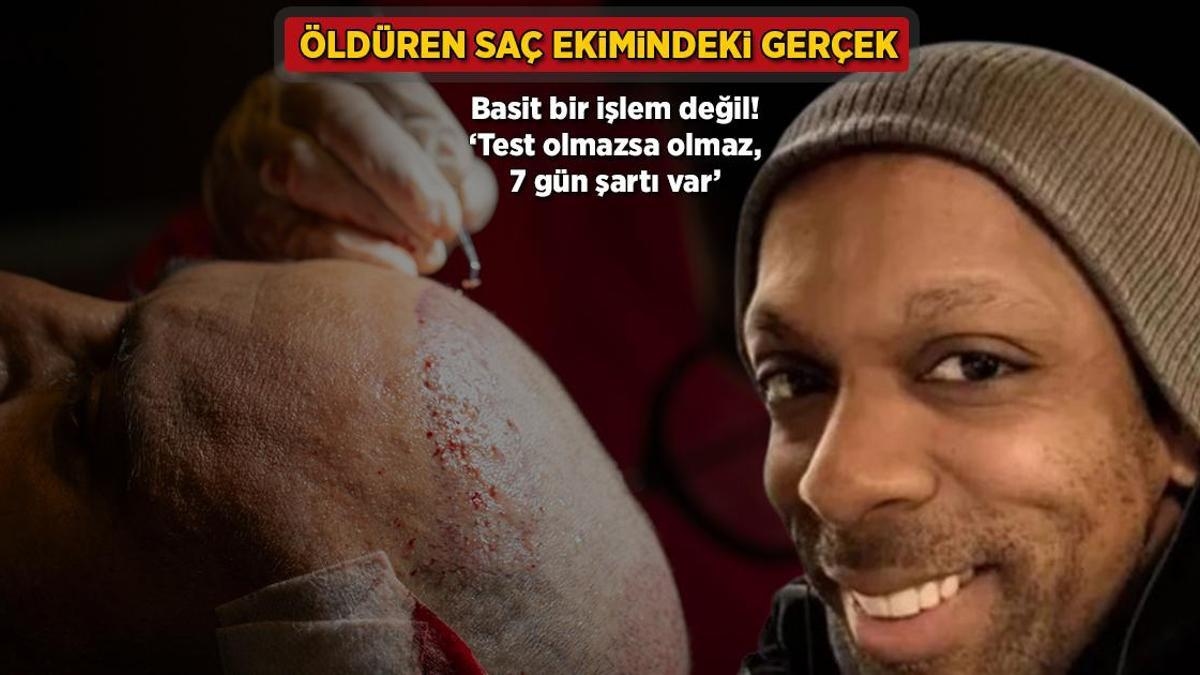 Die Wahrheit über tödliche Haartransplantationen! Es ist kein einfacher Eingriff: „Tests sind unerlässlich, es besteht eine 7-tägige Vorschrift“