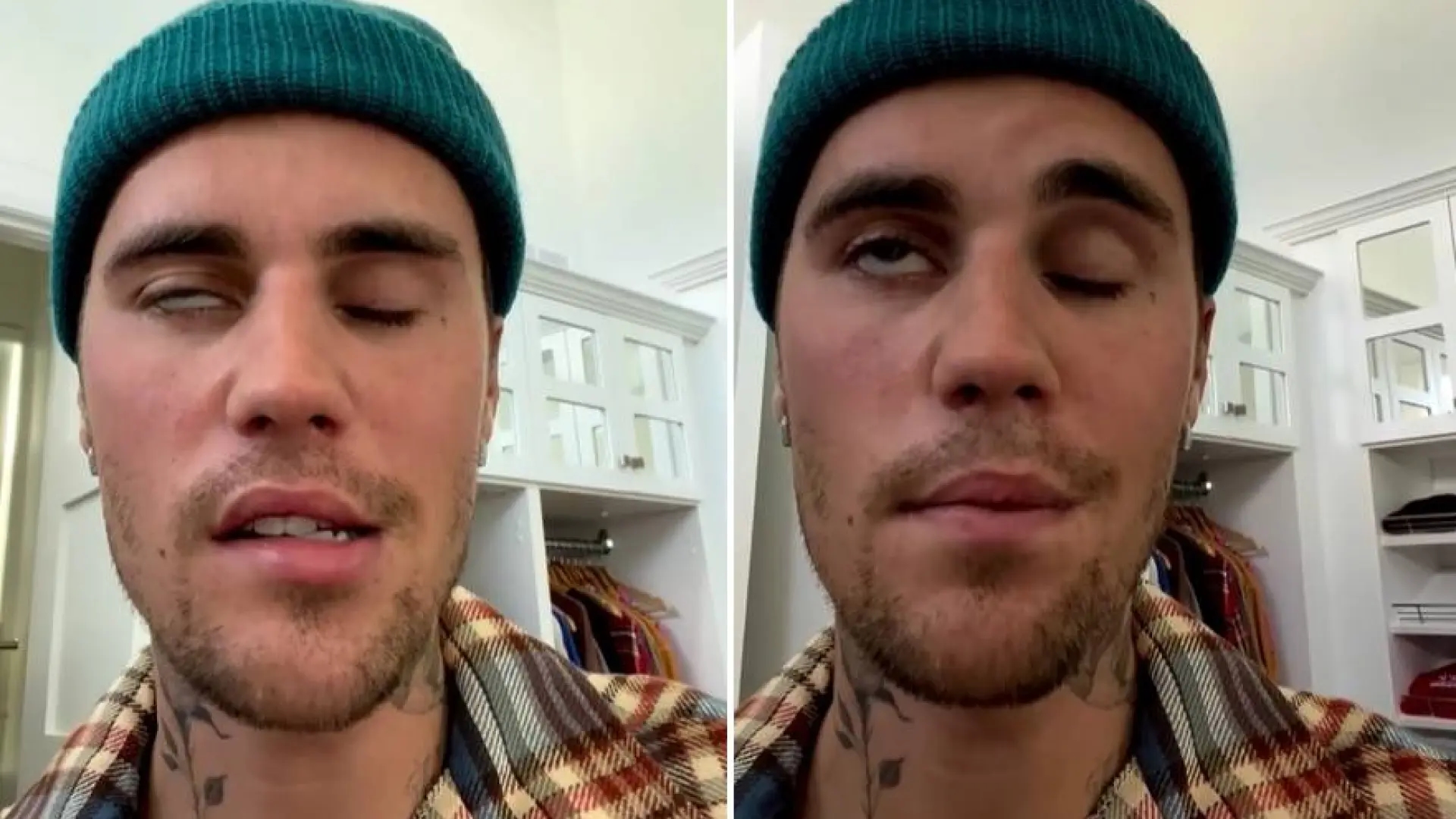 Czym jest zespół Ramsaya Hunta, choroba, na którą cierpiał Justin Bieber i która spowodowała sparaliżowanie połowy jego twarzy?