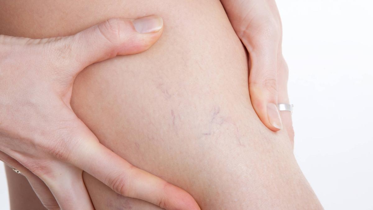 Varicose veins: One in four adults could develop this condition. How can we prevent it?