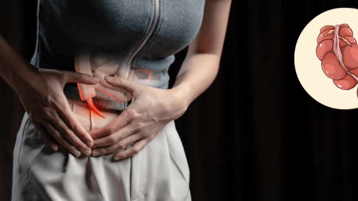 Cáncer de apéndice crece entre los jóvenes: ¿cuáles son los síntomas a los que debe prestarle atención?