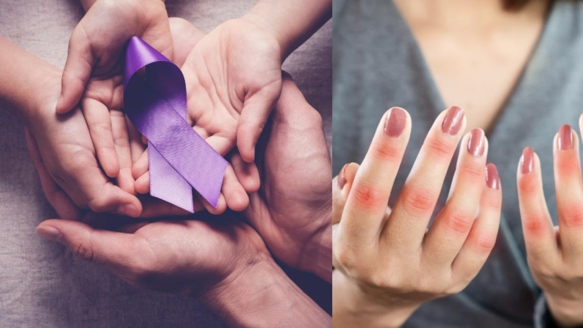 Pacientes con lupus cuentan cómo es vivir con esta enfermedad silenciosa y de difícil diagnóstico