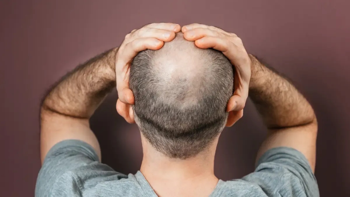 Biofibra, the non-surgical hair implant that arrived in Colombia