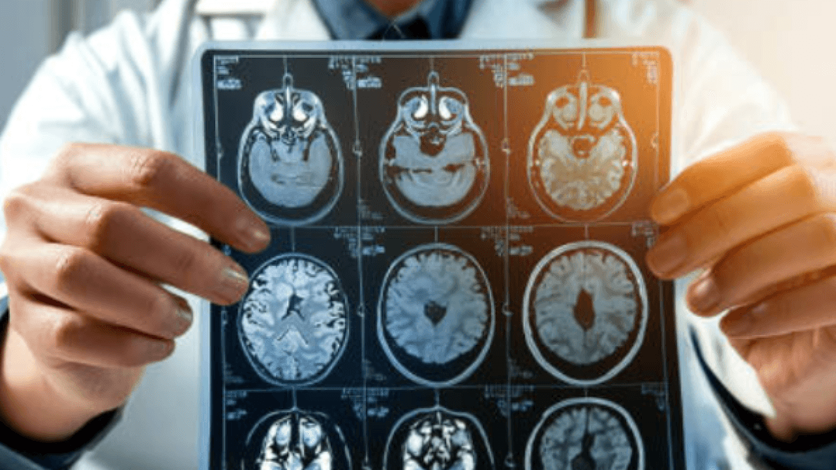 Las personas que más sufren accidentes cerebrovasculares en Colombia, según cifras del Ministerio de Salud