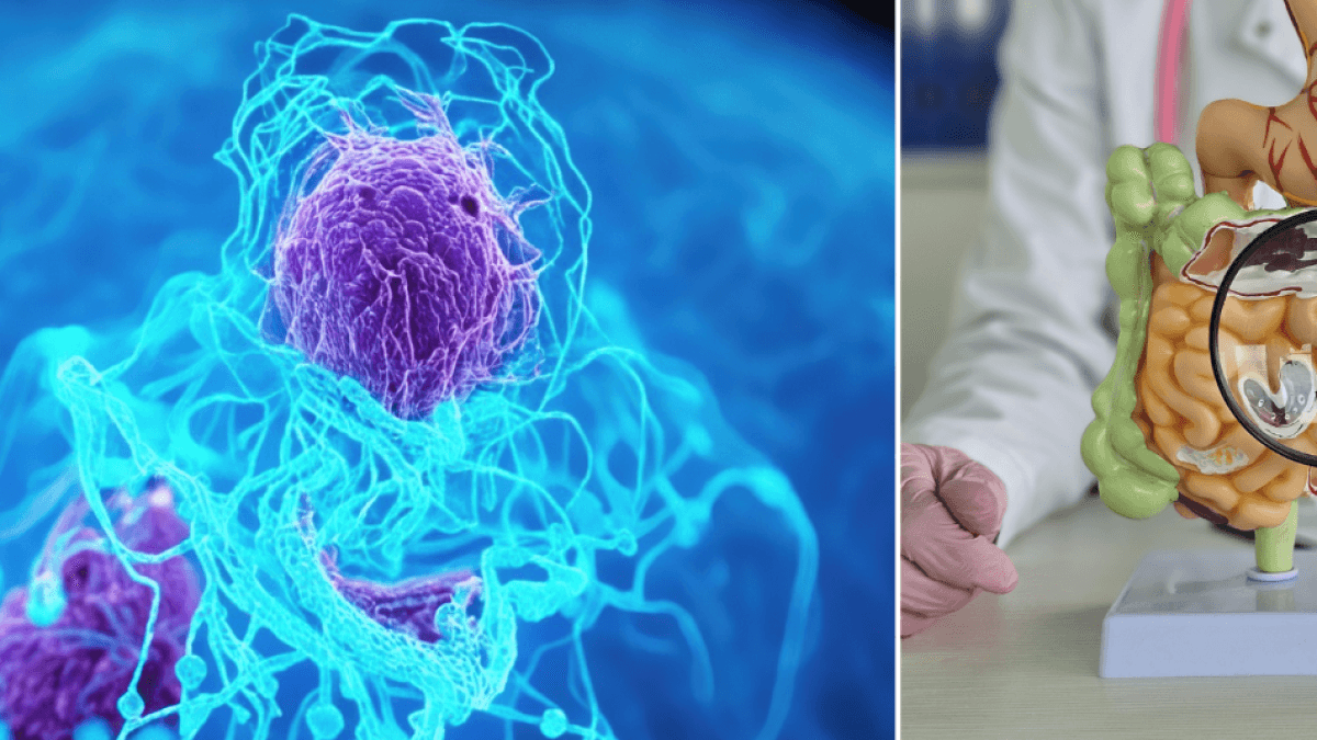 Científicos descubren mecanismo en el cuerpo que inicia el proceso tumoral de cáncer de colon