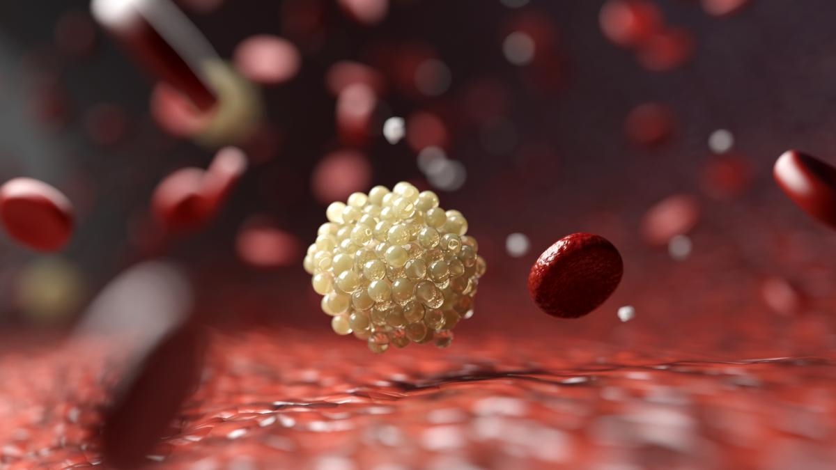Researchers manage to reduce "bad" cholesterol by almost half using combination therapy with a new drug.