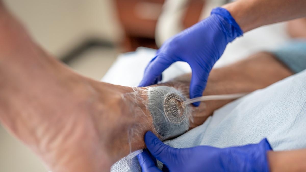 La innovadora terapia que acelera hasta en 50 % la cicatrización de heridas graves y quemaduras