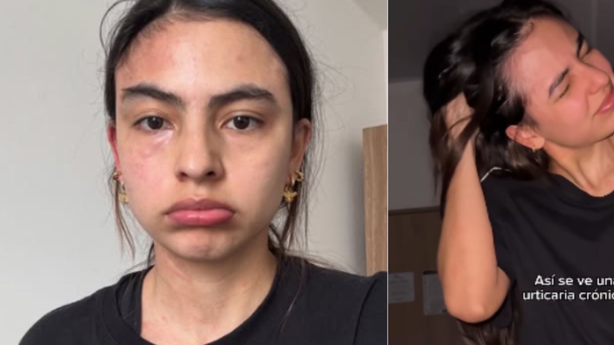 Michell Orozco, actriz de ‘Lady, la vendedora de rosas’, lleva tres meses sin poder dormir por una crisis de urticaria crónica: ‘Ha sido horrible’