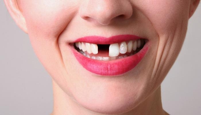 Achten Sie auf Ihre Mundgesundheit! Die versteckte Ursache für Reizdarmsyndrom können Ihre Zähne sein: Sie erhöhen das Risiko um 103 Prozent! Beeinträchtigt Zahnverlust den Darm? Welche Symptome treten bei Zahnverlust auf?
