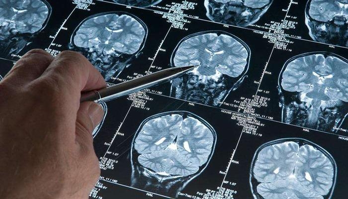 Versteckte Gefahr bei Männern! In Alzheimer-Studien wurde eine genetische Variante gefunden, die das Demenzrisiko erhöht: Das Risiko, bei Männern mit dieser Variante zu erkranken, liegt bei 2,39