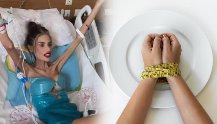 Es handelt sich nicht um eine Hungerkrankheit, sondern um eine tödliche psychische Störung! Was ist Anorexia nervosa? Wie wird Anorexie behandelt?