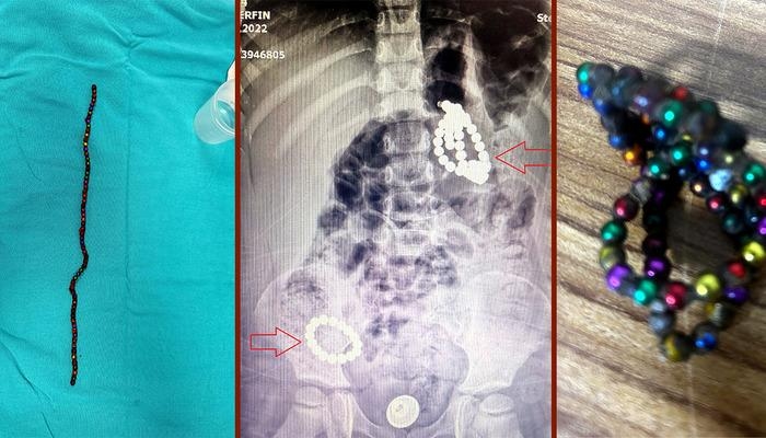 Dieses Spielzeug ist eine tödliche Falle! Schockierender Fall: Dreijährige lebte monatelang mit 66 Magneten im Bauch! Warnung: „Es durchsticht ihre inneren Organe.“
