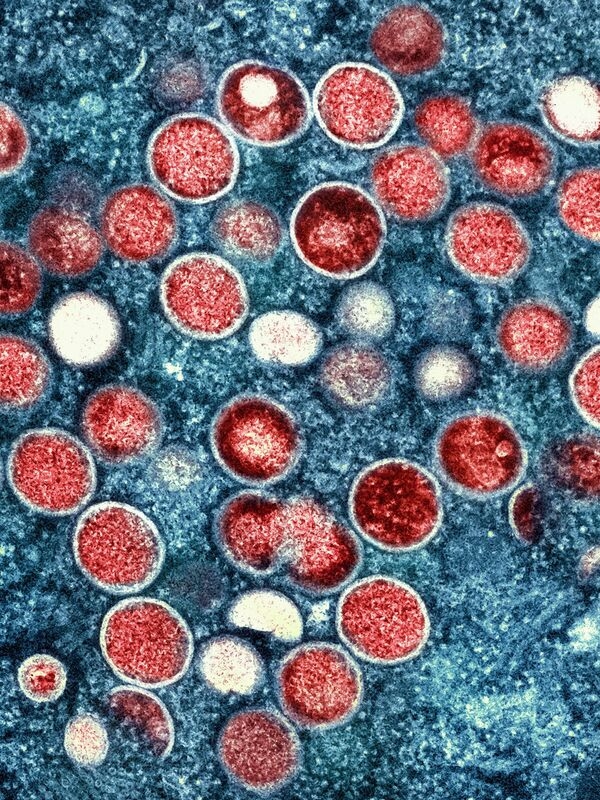 Wirus Mpox przenoszony jest głównie drogą płciową między mężczyznami.