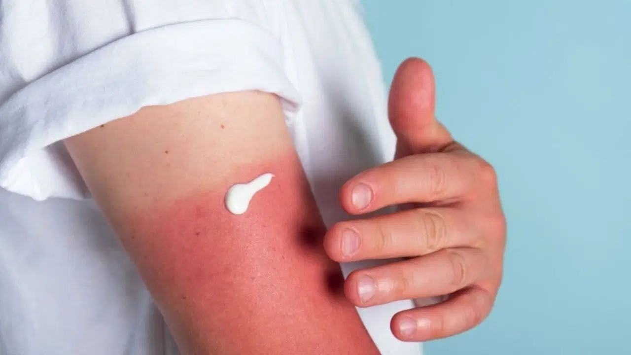 Was hilft gegen Sonnenbrand? 7 natürliche Methoden, die zu Hause angewendet werden können