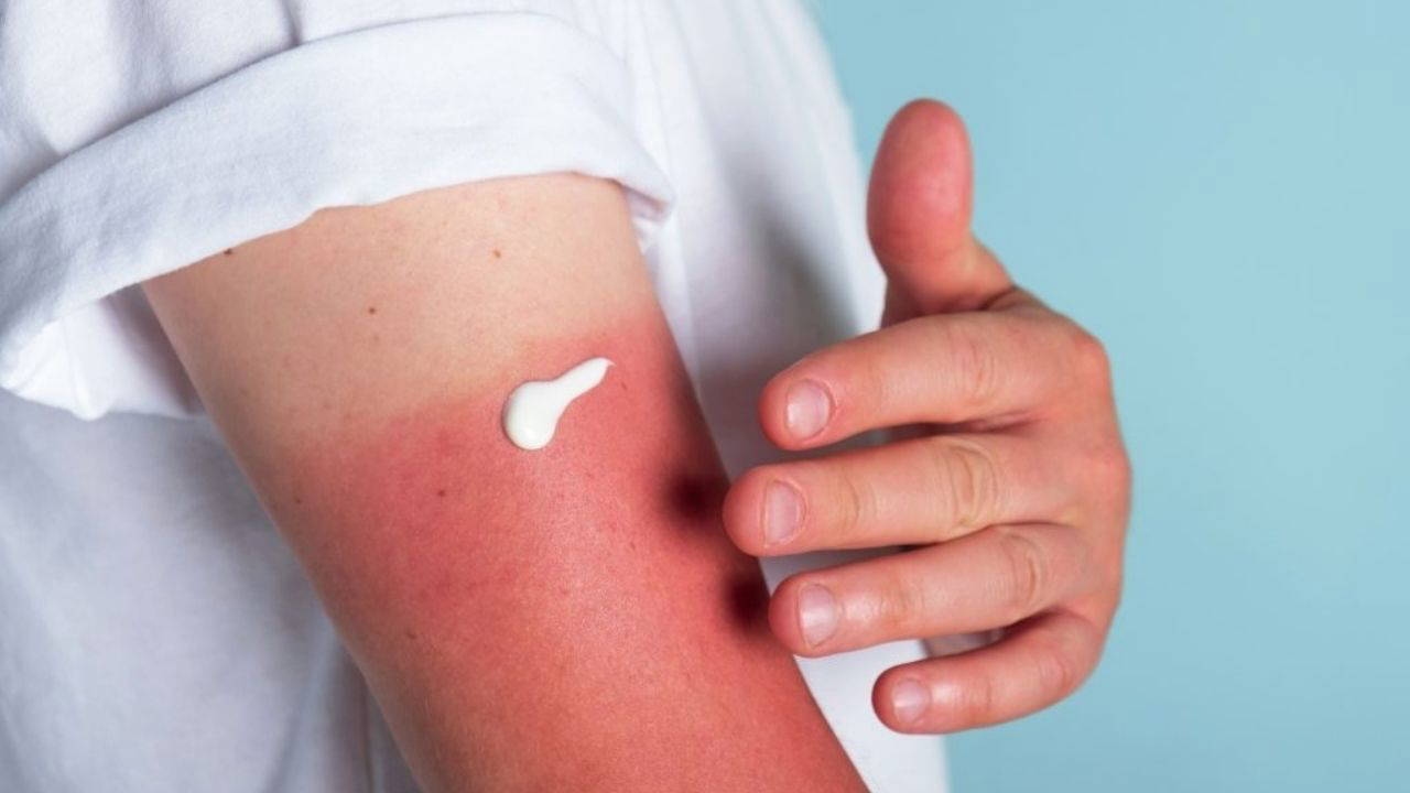 Experte warnt: „Sonnenbrände können auch Jahre später noch Hautkrebs verursachen“