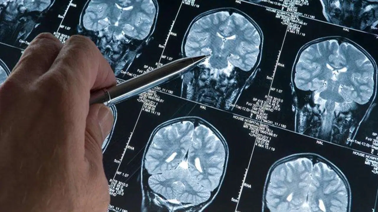 Een nieuwe stap in vroege diagnose: het 'bloedtest'-tijdperk bij Alzheimer