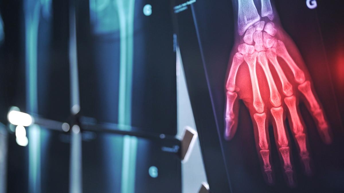 Osteoarthritis, eine wenig verstandene und komplexe Krankheit