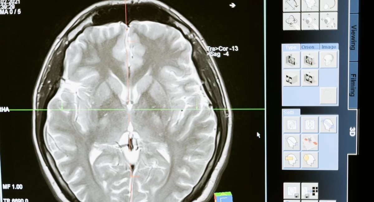 Does Menstruation Affect the Brain? Scientists Reveal Surprising Structural Changes