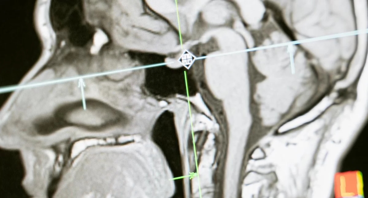 CT-scan is niet voldoende. Hersendood vereist nog steeds klinische evaluatie.