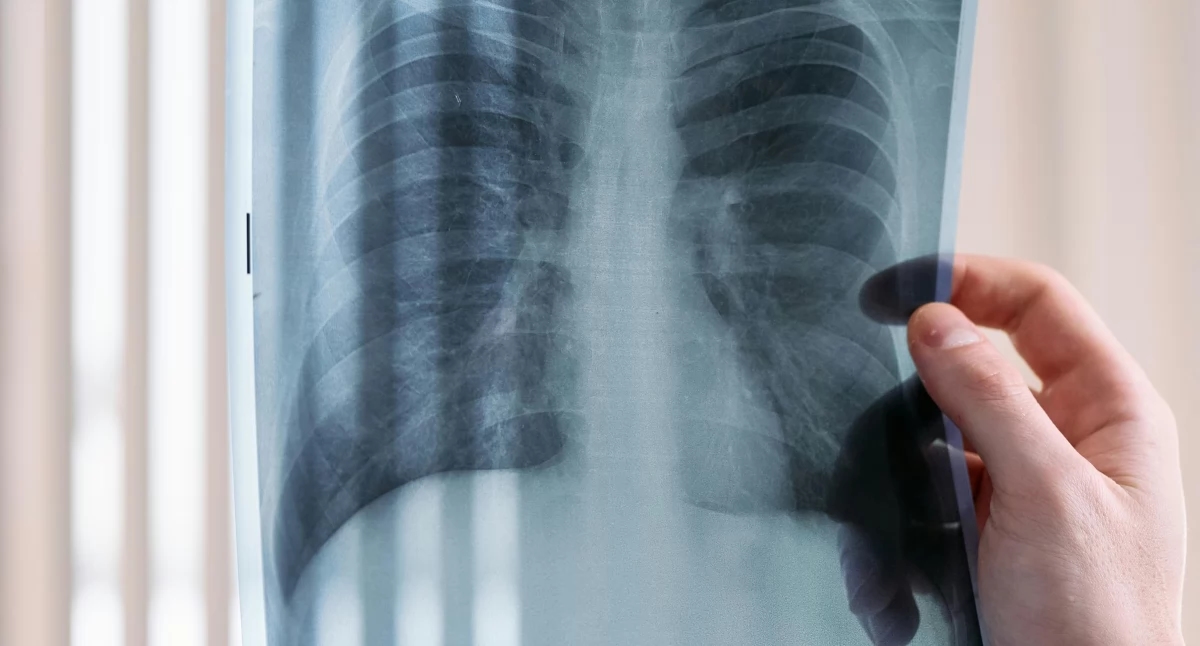 Lungenkrebs breitet sich in Polen zu einer Epidemie aus. Experten: „Die Diagnose dauert so lange, dass der Patient nicht mehr für eine Behandlung in Frage kommt.“