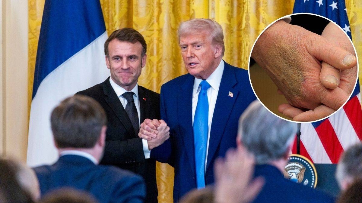 Amerikanen maken zich zorgen over de aanblik van Trumps hand. Het Witte Huis legt uit