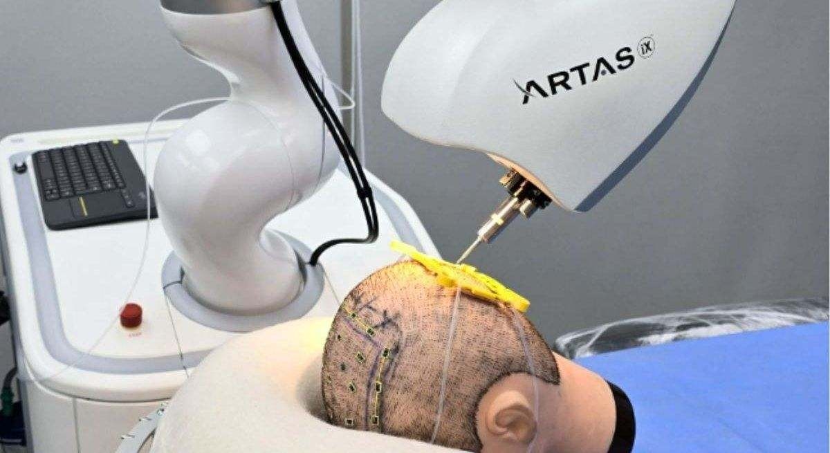 Kunstmatige intelligentie belooft alopecia te genezen: dit is ARTAS iX, de robot die u uw haar teruggeeft.