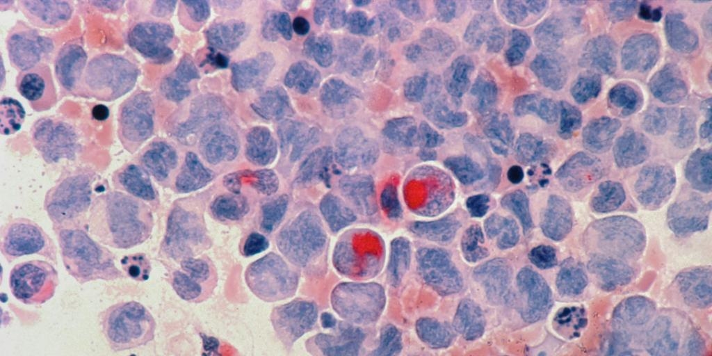 Il s’agit du cancer « oublié » qui connaît la plus forte augmentation chez les jeunes.