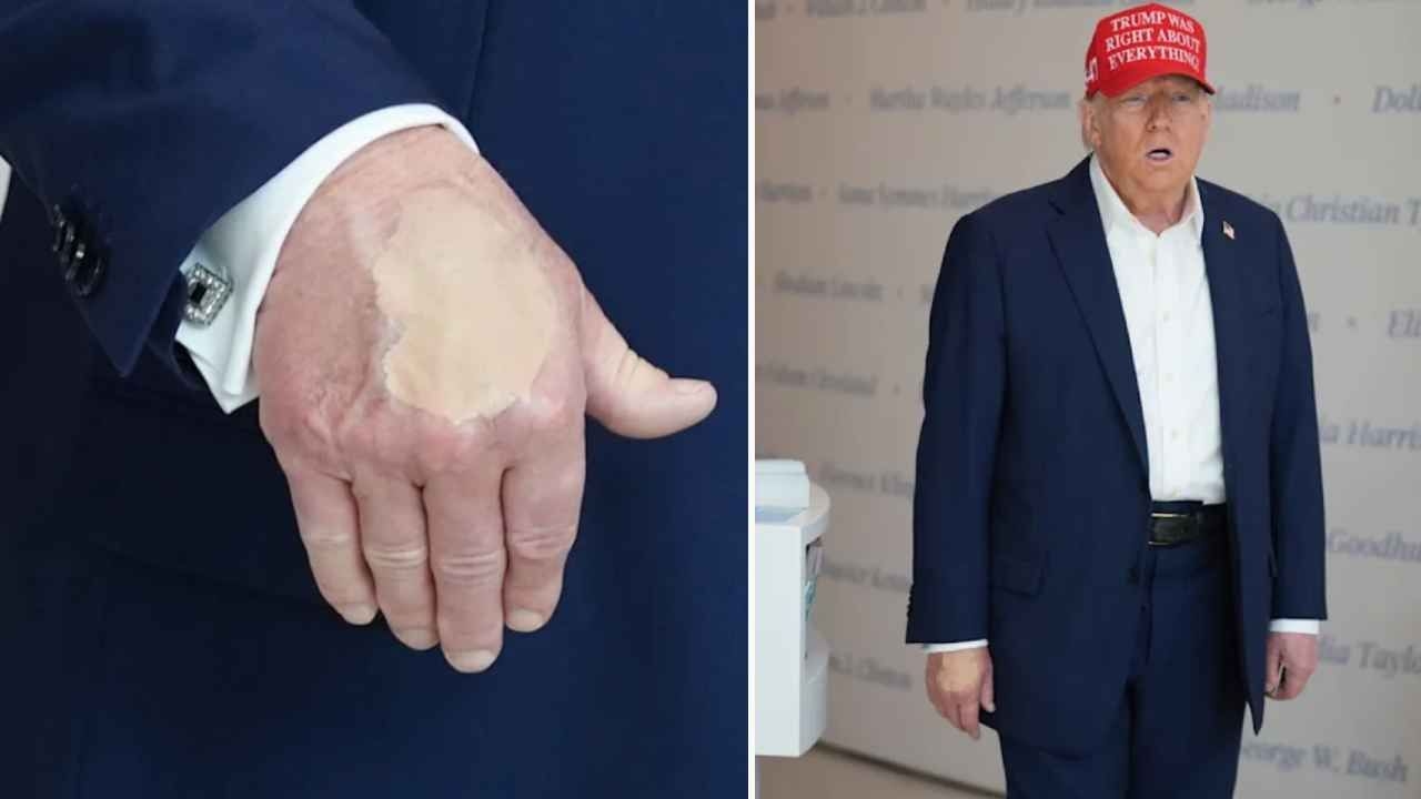 Il trucco sulla sua mano è diventato argomento di discussione! Dichiarazione degli Stati Uniti sulla salute di Trump