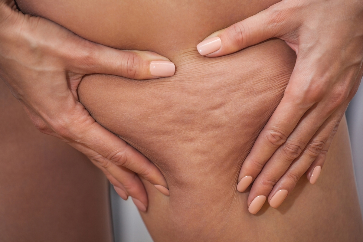 Personal trainer legt uit hoe je cellulitis kunt 'elimineren' met fysieke activiteit