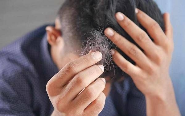 Dermatologist: "With alopecia areata, discomfort and high costs, modernize guidelines"