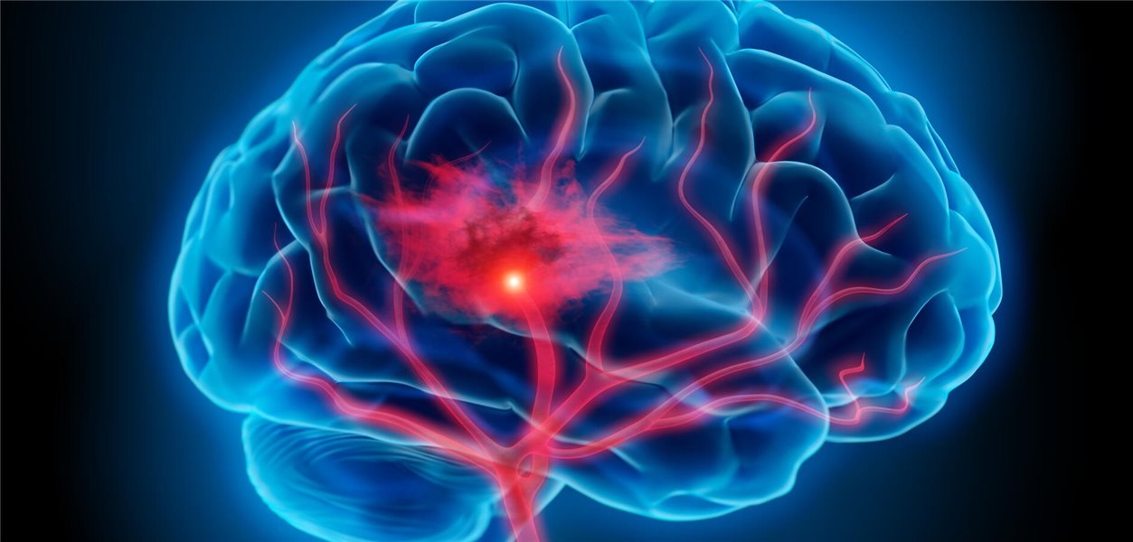 Kalıcı foramen ovale: Genç inme hastalarında daha fazla tanı