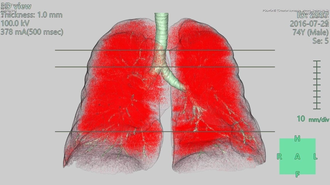 Pulmonale Hypertonie: Neues Medikament reduziert Verschlechterung