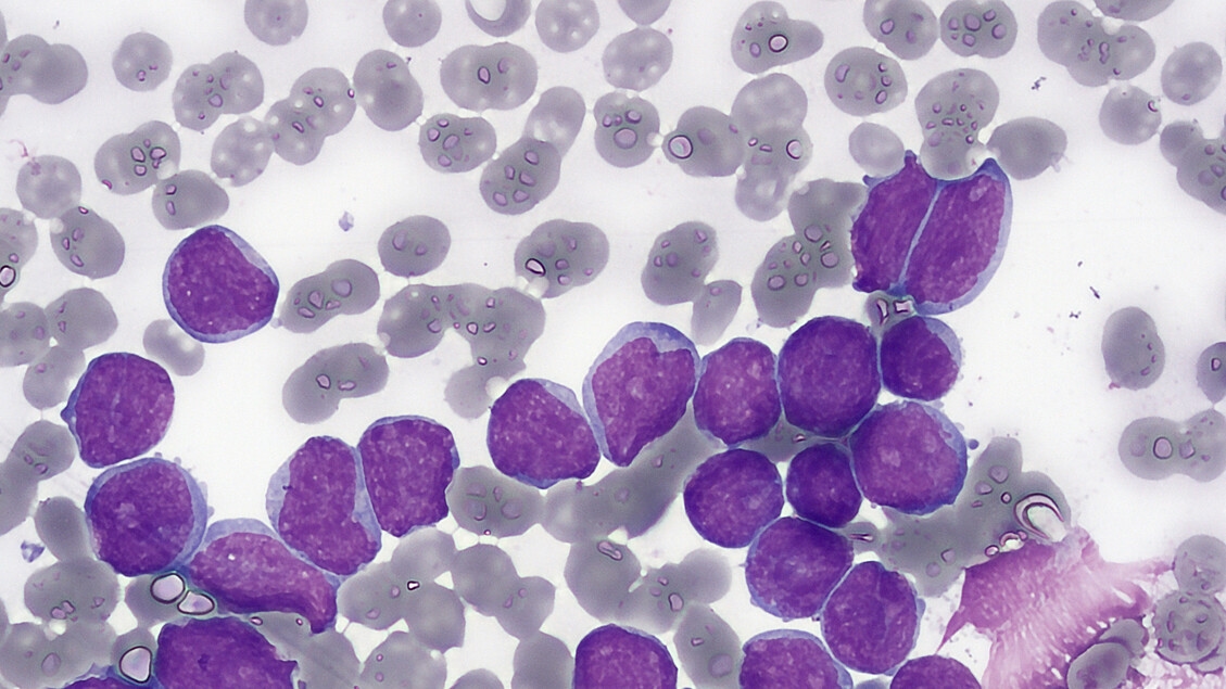 Erste Tests einer Therapie gegen den häufigsten Tumor bei Kindern verlaufen gut